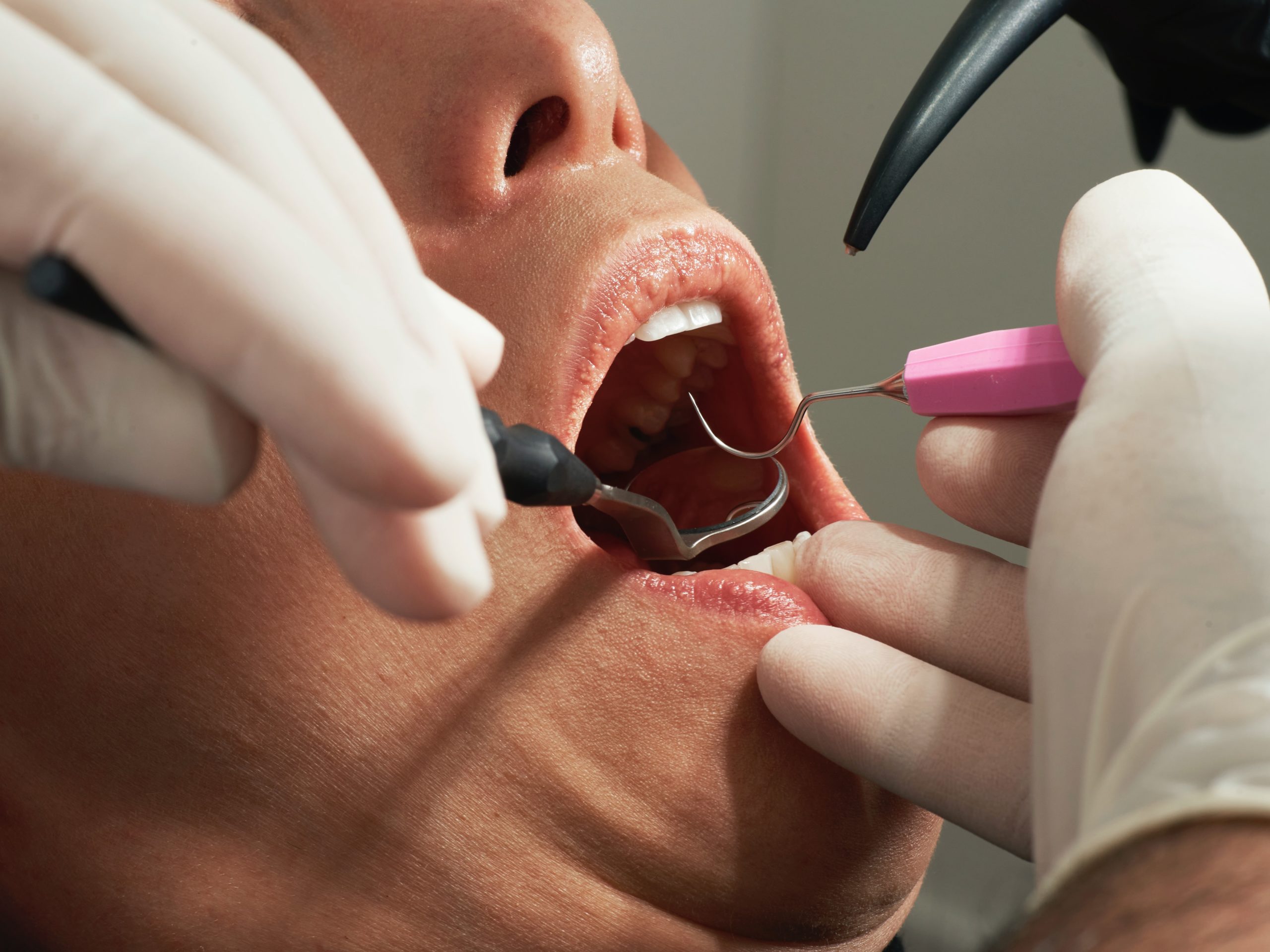 «Διάχυτη αγανάκτηση» των οδοντιάτρων: Rapid test για εμβολιασμένους – Αρνητικό μοριακό για τους ανεμβολίαστους (video)