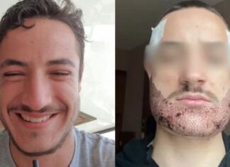 24χρονος αυτοκτόνησε μετά από αποτυχημένη επέμβαση για μούσια στην Κωνσταντινούπολη – Δείτε το πριν και το μετά